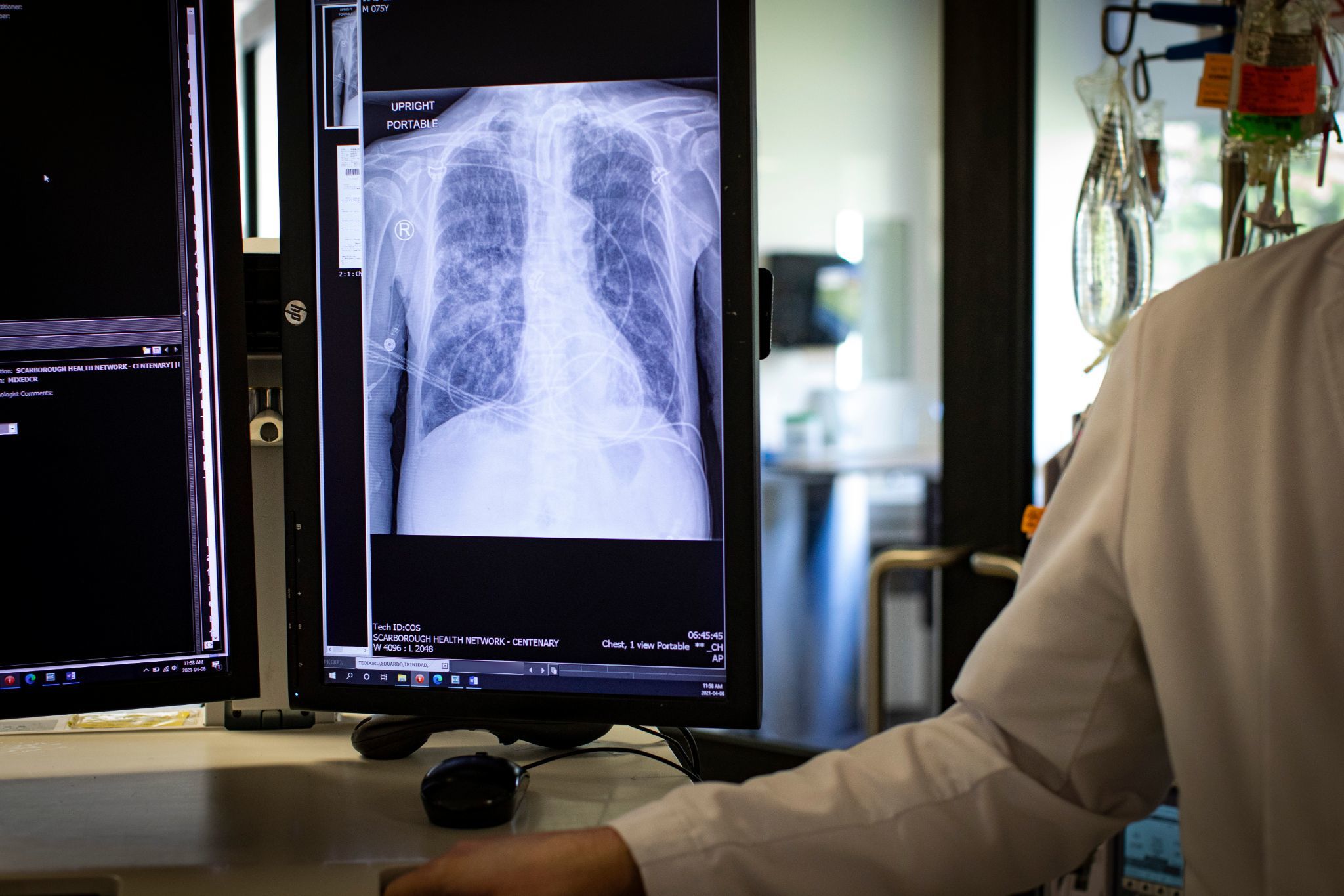 This is how Eduardo Teodoro's lungs look on a scan following his COVID-19 infection in January and several months in the ICU. (Evan Mitsui/CBC)