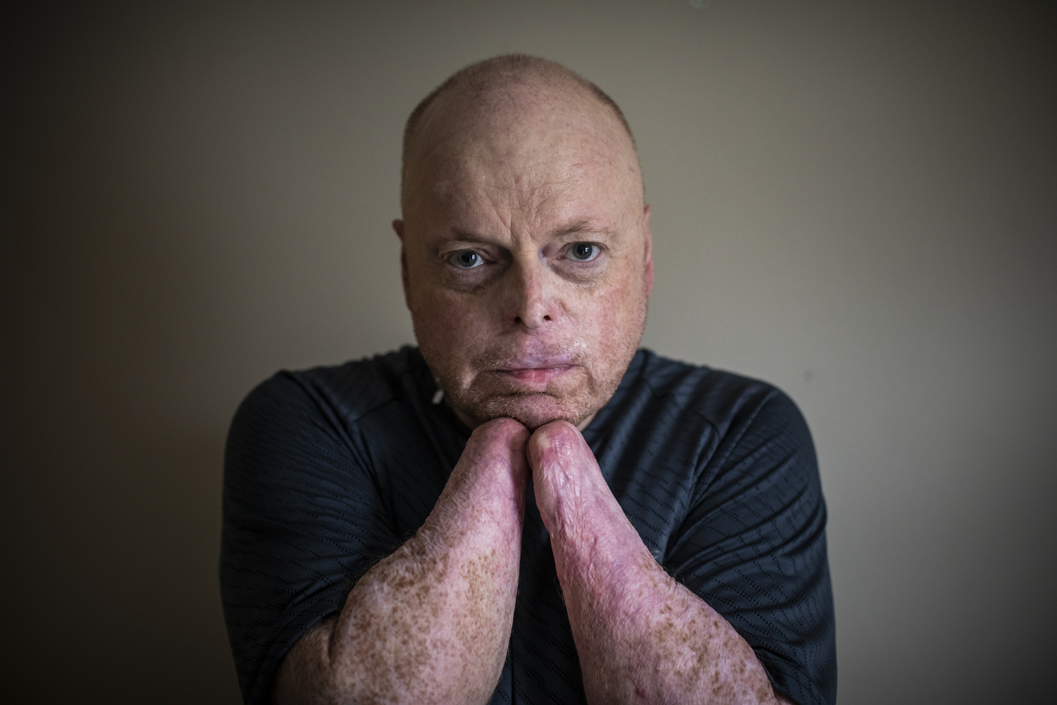 Richard Thompson, who has been selected as a candidate for Canada’s first double hand transplant, pictured in his apartment in Coquitlam, B.C., on Feb. 27, 2020. (Ben Nelms/CBC Vancouver)