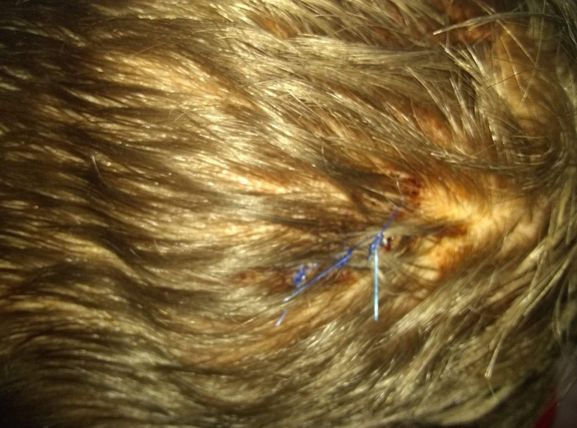 On March 16, near the end of a challenging day, the boy threw batteries at his caregivers, who responded by putting him in a three-person hold. During this altercation, the boy hit his head and had to be taken to the hospital for stitches. (Submitted by child's mother)